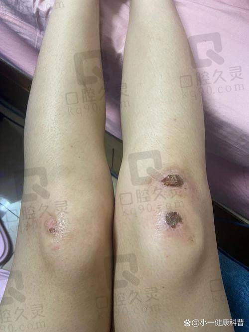 昆明华美美莱整形医院怎么样：治疗后的惊喜改变