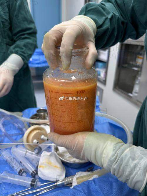 北京协和王阳吸脂价格真不贵，给你亲民价格轻松告别身材焦虑！