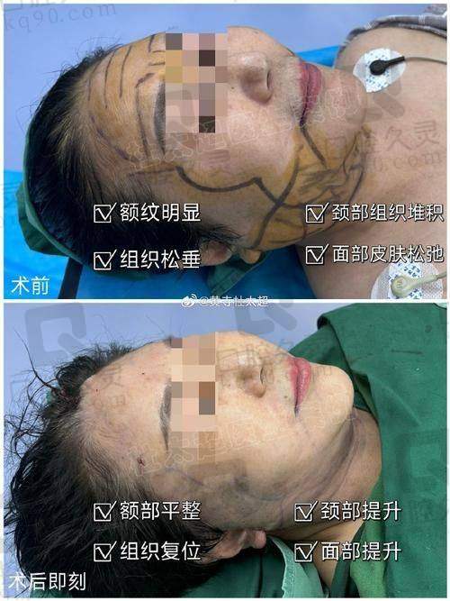 做完拉皮除皱手术，对我的生活有什么改变？