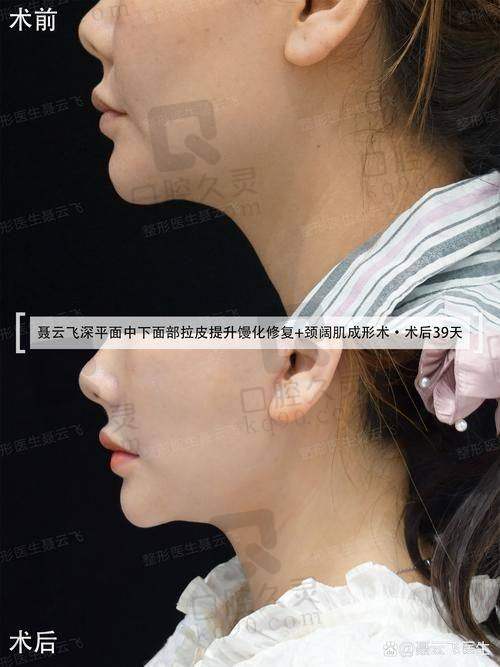 广州壹加壹医院拉皮除皱技术有什么特色？