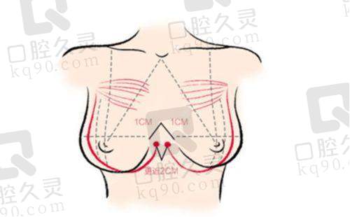 杭州维多利亚刘中策医生假体隆胸体验，塑造自然饱满胸部，术后效果让我超满意 
