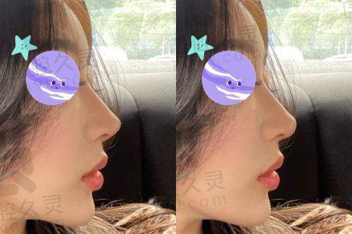 三、郑文涛医生隆鼻的真人实例