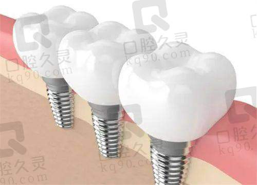 重庆成佳牙博士口腔医院种植牙实力