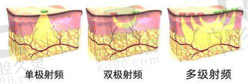 影响杭州维多利亚医疗美容医院假体隆胸费用的因素