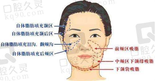刘中策医生的隆胸技术特色