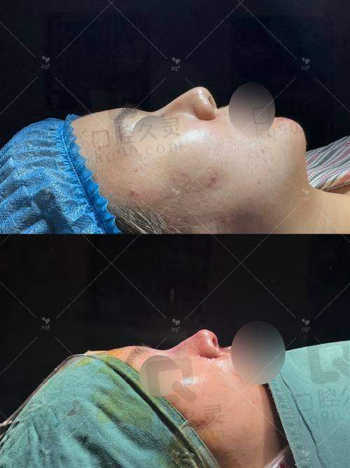 四、郑文涛医生打造明星同款鼻子的秘诀