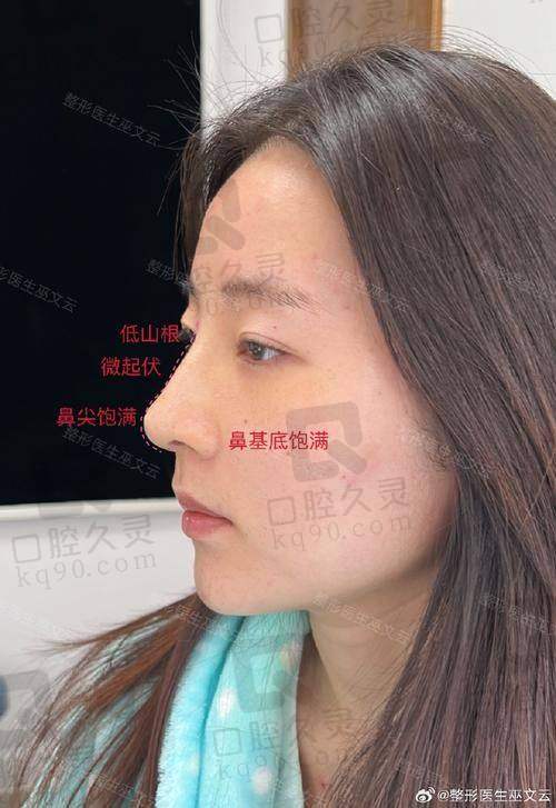 二、郑文涛医生隆鼻的核心技术优势