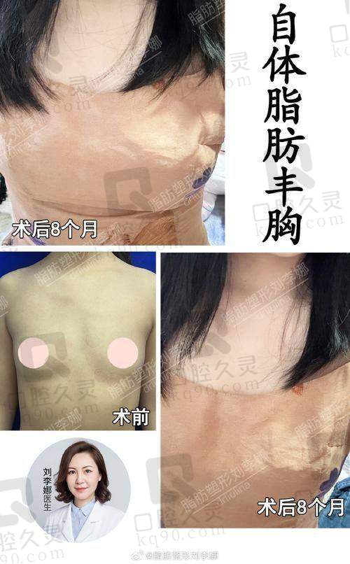 杭州维多利亚刘中策做假体隆胸靠谱吗？专业多维度解析给你答案 