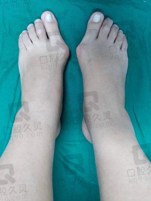 苏敬达大脚骨手术要截骨吗?专业解答,解析手术方式与截骨必要性