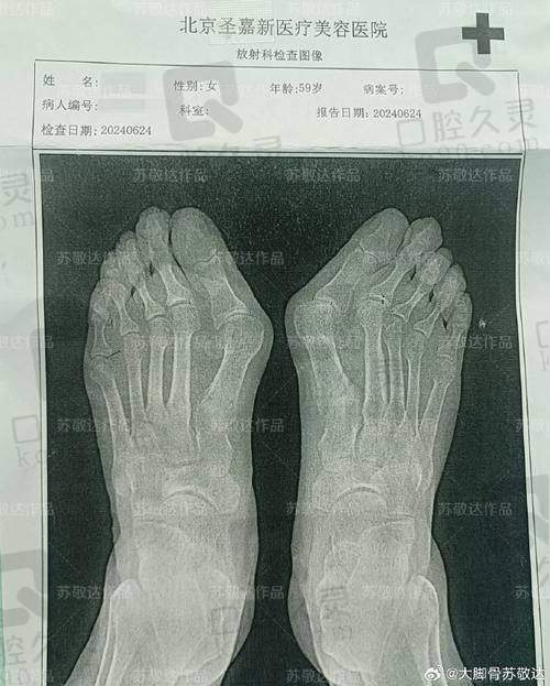苏敬达大脚骨手术贵不贵？费用合理效果优，专业技术助力足部健康重塑 