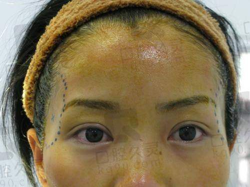 广州海峡医学整形美容医院自体脂肪填太阳穴哪个医生好？闫伦、闫爱跃医生值得了解