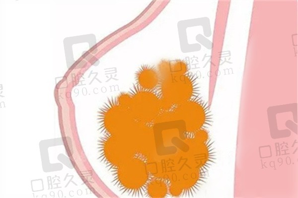 广州海峡医学整形美容医院谭新东擅长做什么？隆胸、异物取出及修复等超厉害