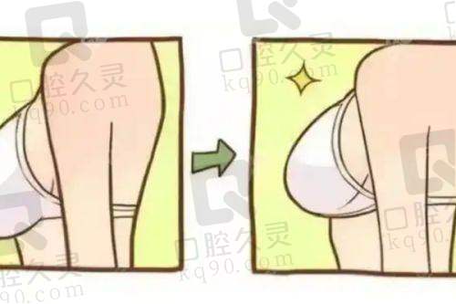 杭州维多利亚医疗美容医院有限公司假体隆胸的术后护理