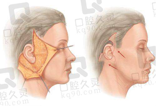 杭州维多利亚刘中策医生假体隆胸案例：张女士从自卑到自信的完美蜕变之旅 