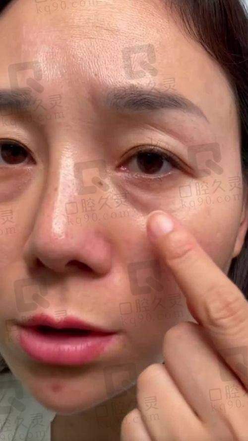 如何预约郑州王剑医生进行祛眼袋手术？