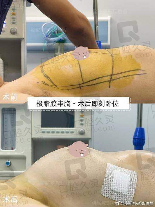杭州维多利亚医疗美容医院有限公司假体隆胸实例展示