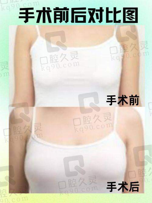 2025杭州维多利亚医疗美容医院有假体隆胸价格表，收费价格及相关优势全揭秘 