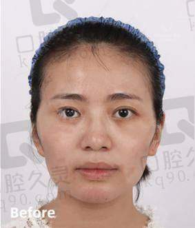 自体脂肪填充选王明利靠谱吗？他经验足技术优，术后效果自然且感染风险低 