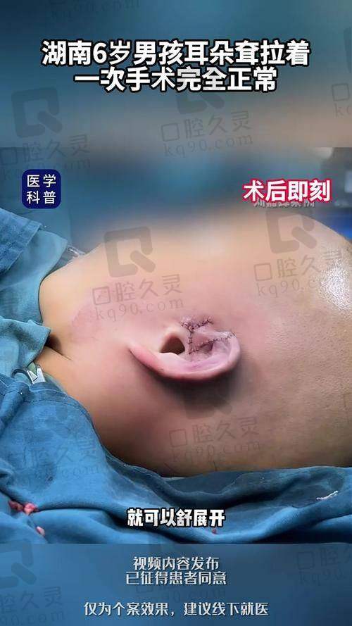 郭树忠失败修复实例：哪些人适合重新造耳？适应症与术式解析