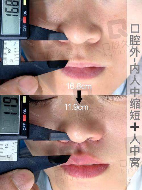 广州海峡医学整形美容医院人中缩短2025年优惠价格6千起！老牌医院口碑好不容错过！ 