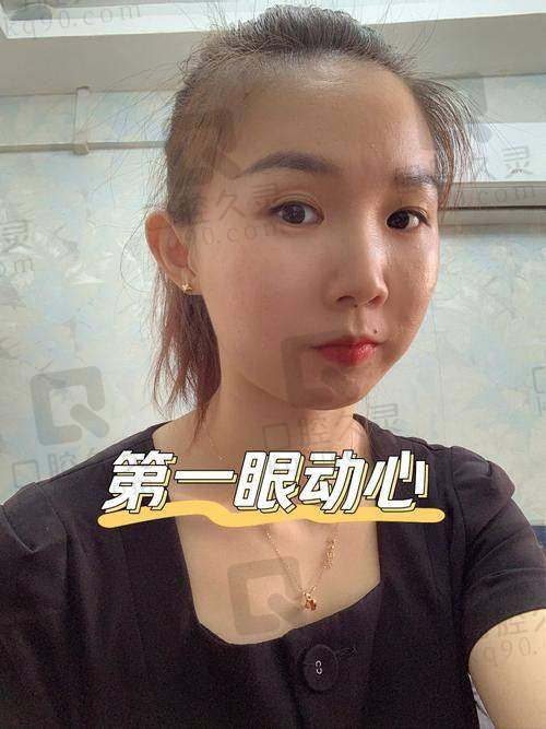 长沙艺星马传勋医生割双眼皮疗效如何？20年经验成就自然无痕、性价比高之选 