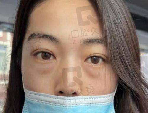 郑州王剑医生简介：专注眼部整形十余年，技术细腻服务周到