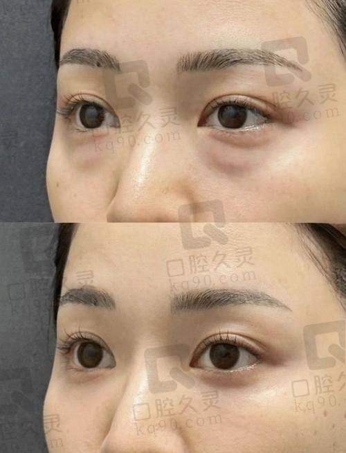 王剑医生识别6种眼袋类型，精细手术不盲做