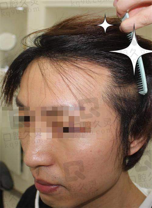 包头吴姝华美医院为何是正规植发医院？技术多样、价格透明、口碑良好优势尽显 