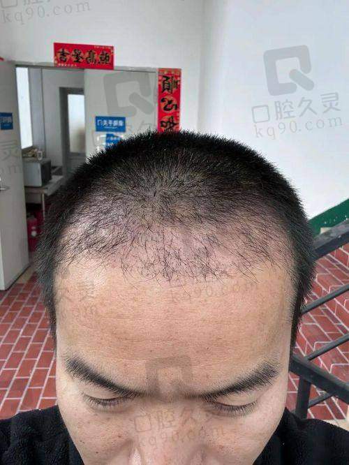 盐城艺植植发诊所医院收费价格表