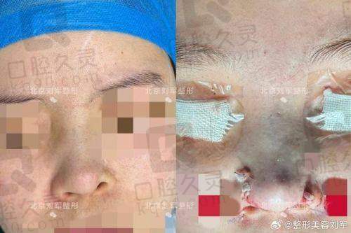 上海李健隆鼻修复效果如何？30 年经验医生，个性化方案打造自然持久美鼻 