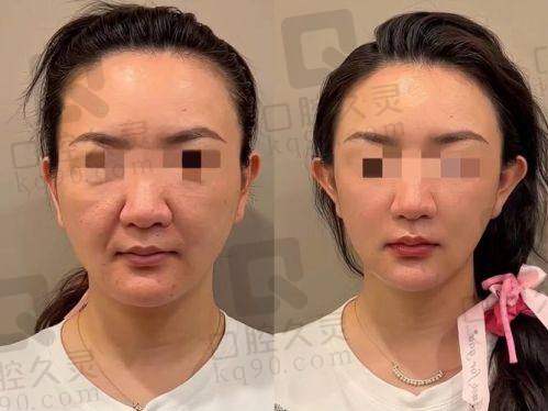 南宁华美整形美容医院布莱恩.肯尼博士医生优势有哪些？拉皮光疗精细手术助你变美