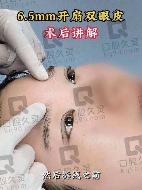 郑州邵志明医生做双眼皮案例大赏，修复技术惊艳，价格还亲民！