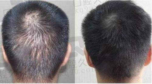 植发到底是不是坑人的？看看我的真实植发经历