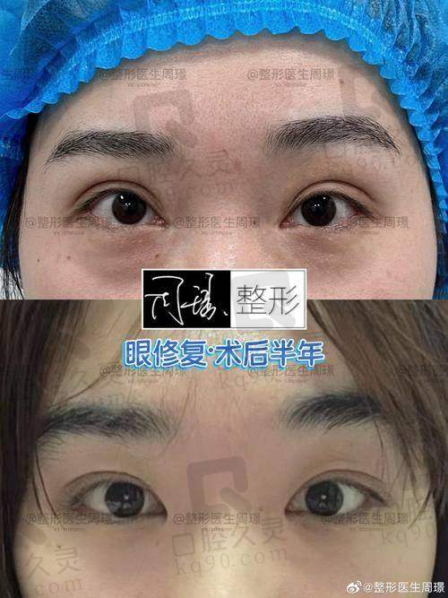 天津南开博莱美哪个医生修复双眼皮厉害？刘旺和许光，技术审美双优铸就灵动双眼 