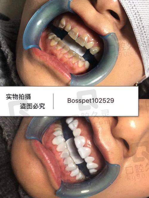 贵港蓝天口腔医院四环素牙不同美白方式价格如何？