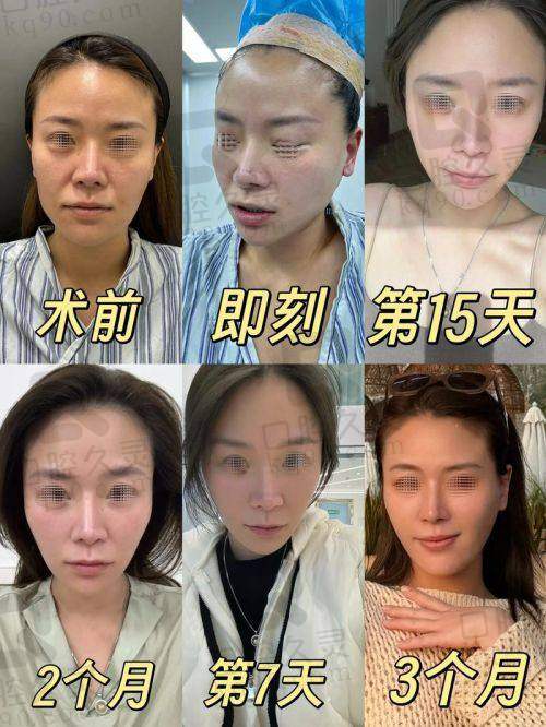 谢洋春医生拉皮手术价格区间