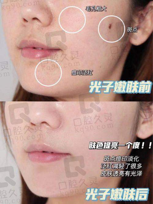 昆明韩辰整形美容医院光子嫩肤大概需要多少钱？1千元起还医生设备优势很突出
