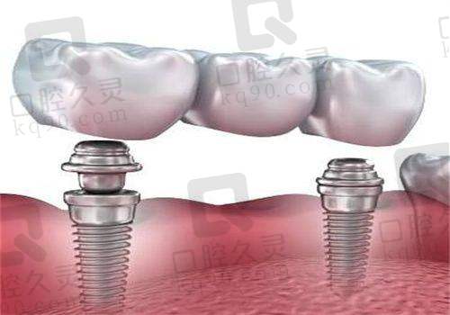 1. 牙博士口腔医院种植牙价格表