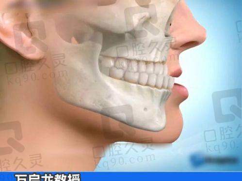 广州何锦泉医生不仅有正颌手术资质，正颌失败修复实例彰显高超医术！