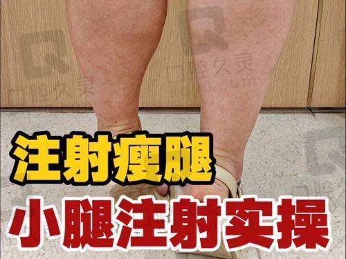 北京画美医疗美容医院注射瘦小腿技术成熟吗？粗腿妹子靠注射告别“萝卜腿”