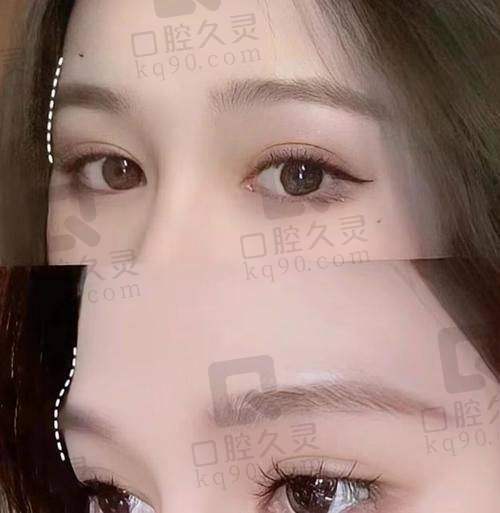广州壹加壹整形美容医院玻尿酸垫眉弓哪个医生做得好？刘轶、苏文新各有优势供你选