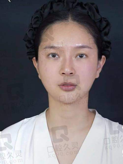 广州壹加壹整形美容医院苏文新医生做玻尿酸垫眉弓技术如何？