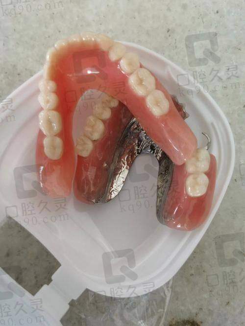 总结：上海中喜口腔医院吸附性义齿值得推荐