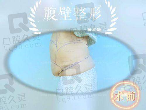 西安崔鑫腹壁整形实例