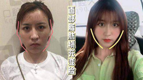 上海华美李健自体脂肪全脸多少钱及详细价格构成分析
