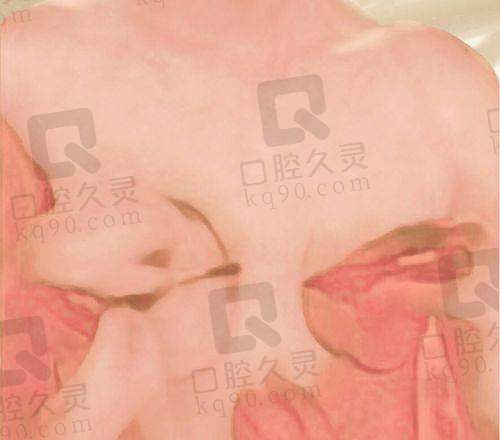 揭秘杭州维多利亚刘中策假体隆胸真实收费，多因素影响价格及方案选择 