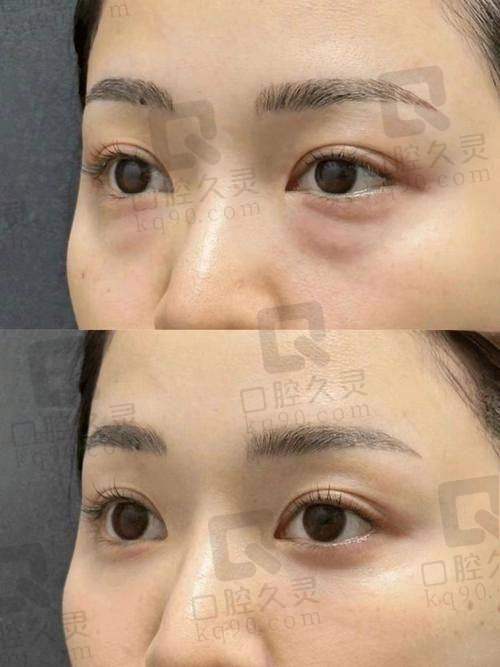 王太玲祛眼袋预约高成功几率技巧
