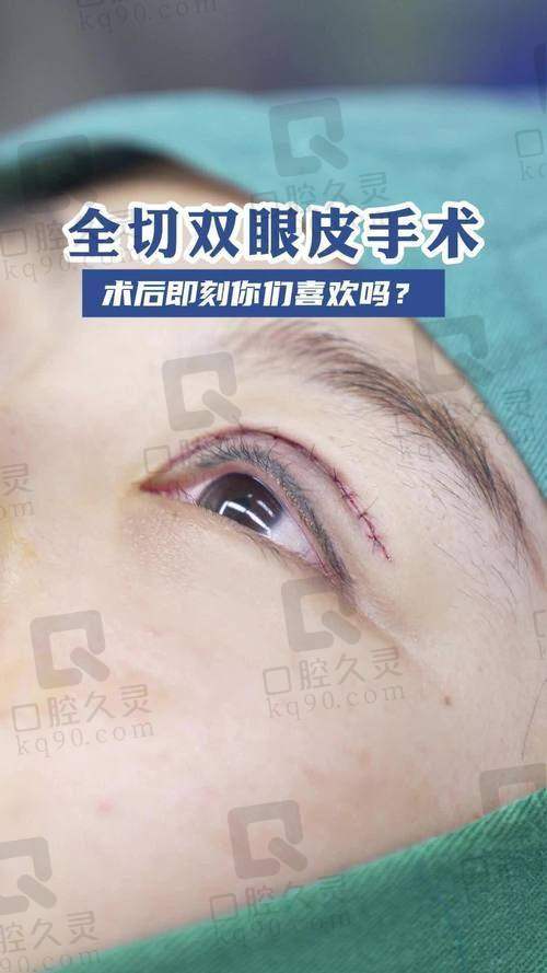 成都高亮双眼皮修复水平怎么样？