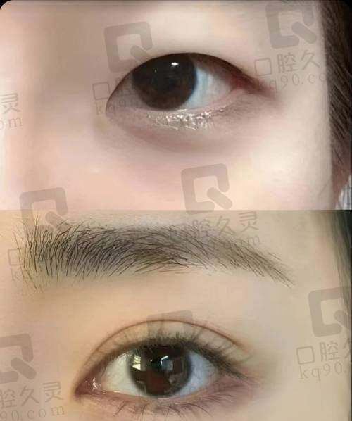 切开双眼皮手术过程是怎样的？我的真实感受