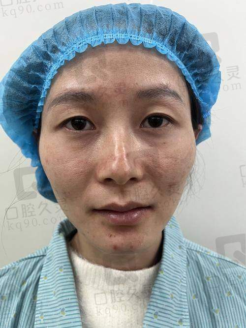 成都高亮双眼皮修复实例